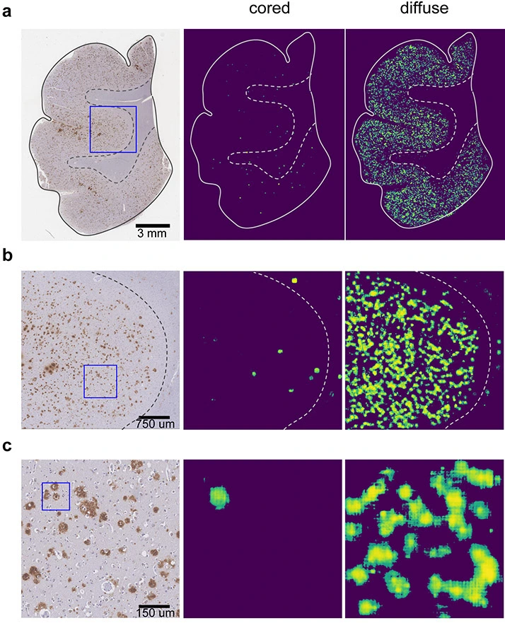 Interpretable classification of Alzheimer's disease pathologies with a convolutional neural network pipeline