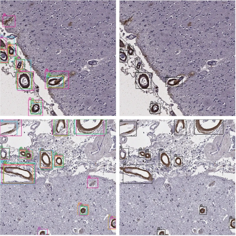 Learning fast and fine-grained detection of amyloid neuropathologies from coarse-grained expert labels