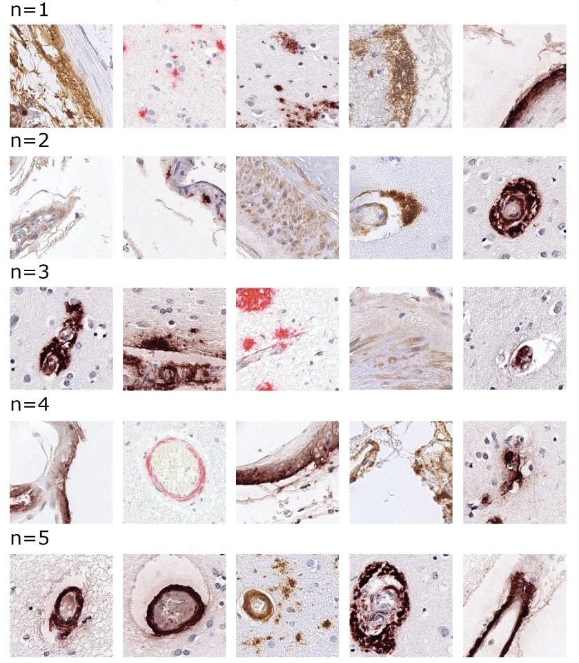 Deep learning from multiple experts improves identification of amyloid neuropathologies