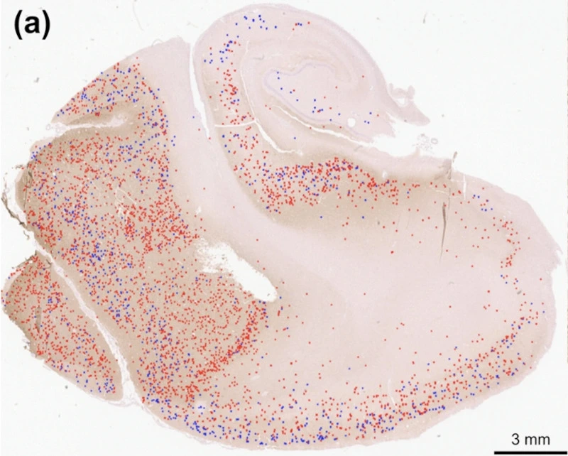Toward a generalizable machine learning workflow for neurodegenerative disease staging with focus on neurofibrillary tangles