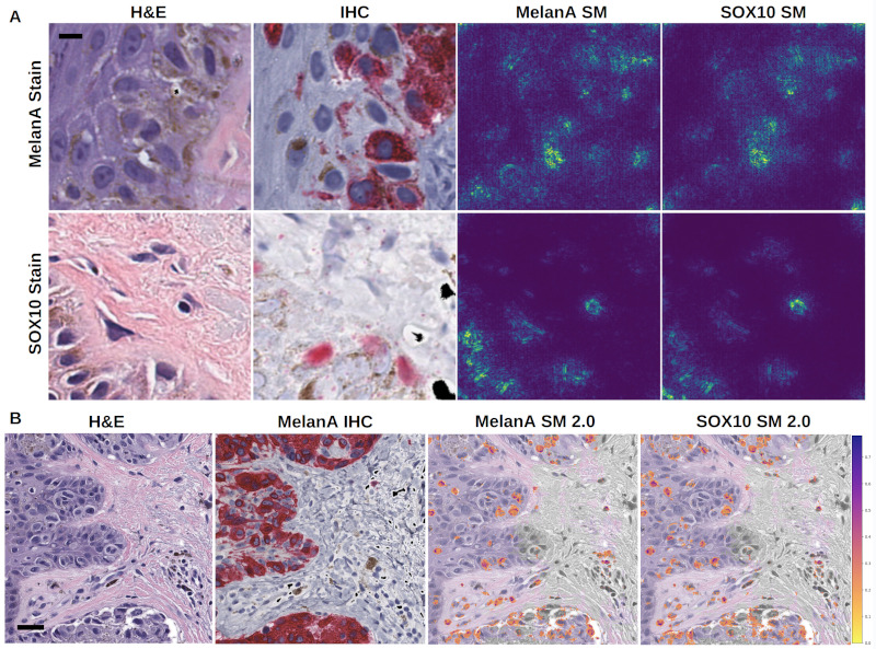 Machine-learning convergent melanocytic morphology despite noisy archival slides